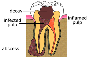 Decayed Tooth