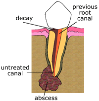 abscess